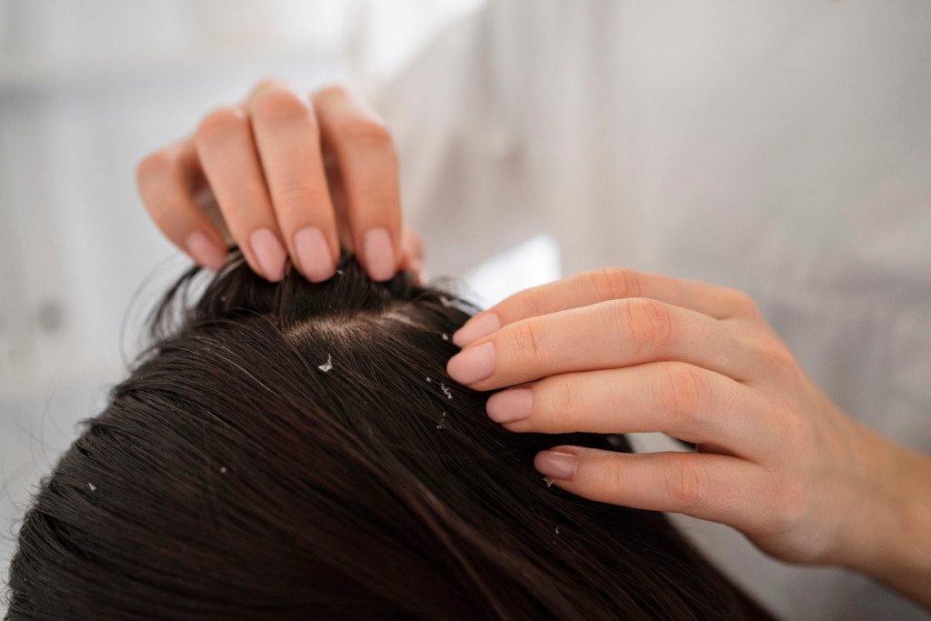 Caspa: 7 errores que pueden empeorarla y cómo cuidar tu cuero cabelludo close up hands touching hair